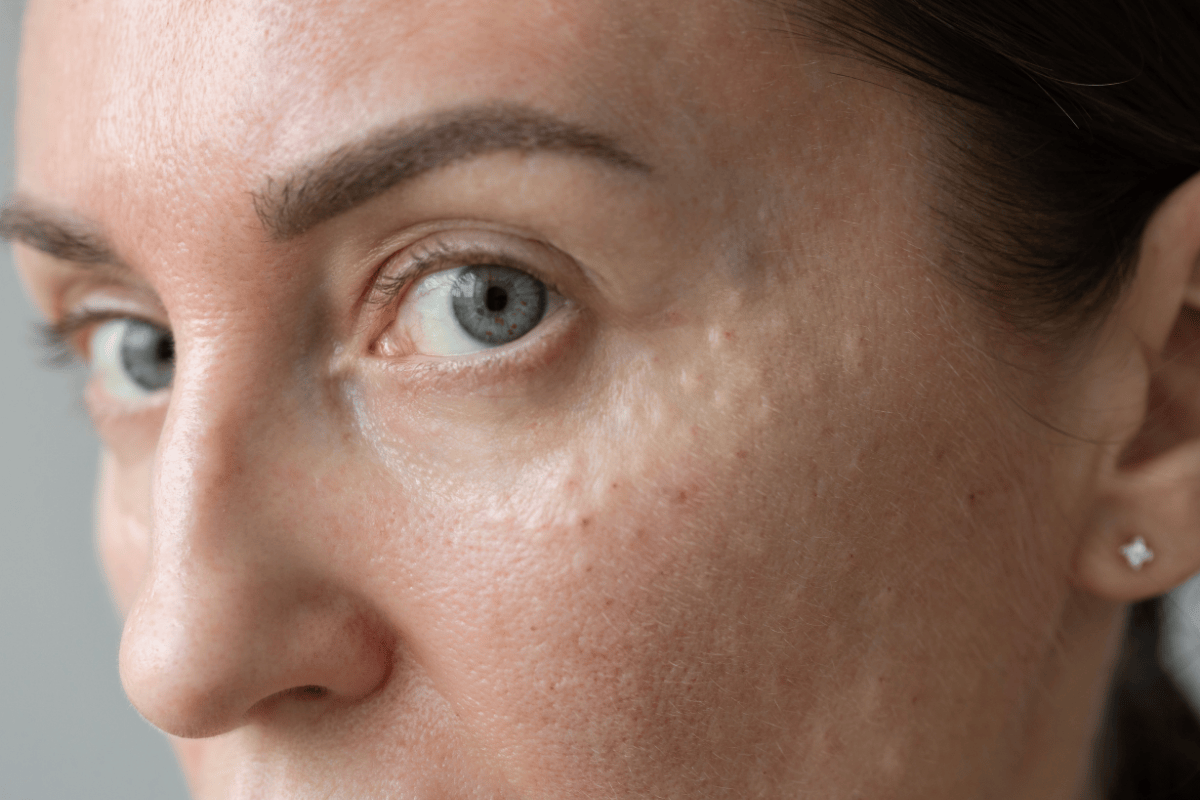 How to remove age spots on your face?